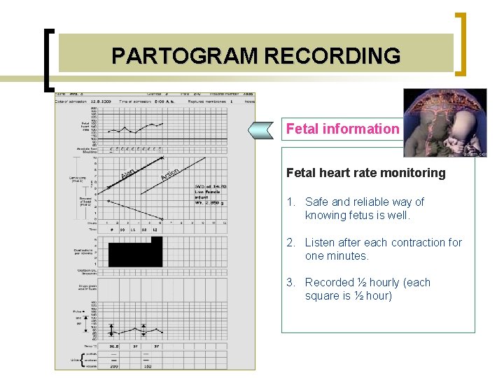 PARTOGRAM RECORDING Fetal information Fetal heart rate monitoring 1. Safe and reliable way of