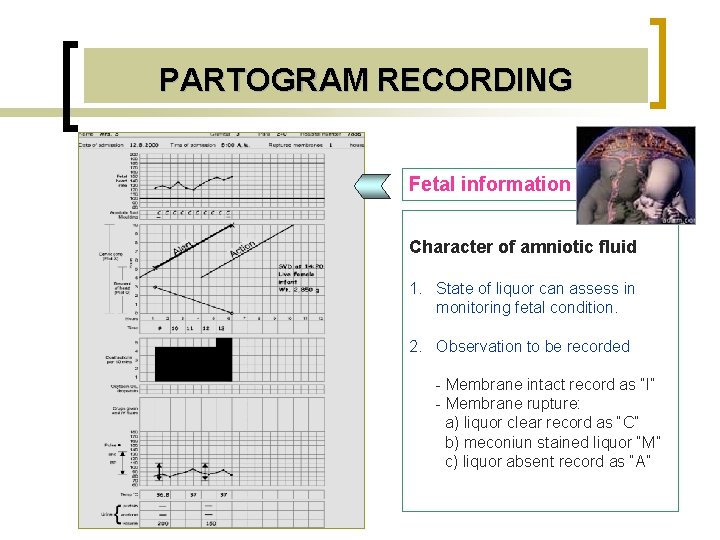 PARTOGRAM RECORDING Fetal information Character of amniotic fluid 1. State of liquor can assess