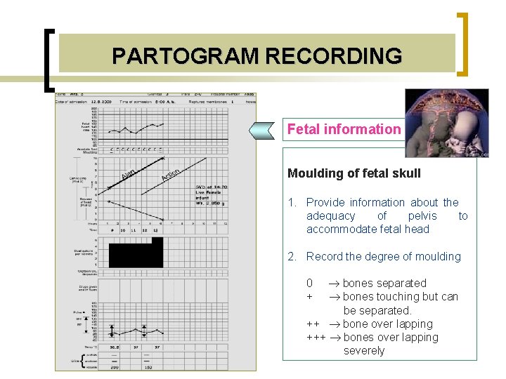 PARTOGRAM RECORDING Fetal information Moulding of fetal skull 1. Provide information about the adequacy