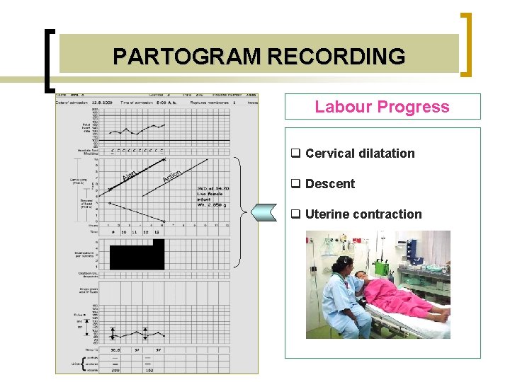 PARTOGRAM RECORDING Labour Progress q Cervical dilatation q Descent q Uterine contraction 