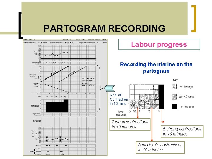 PARTOGRAM RECORDING Labour progress Recording the uterine on the partogram Nos. of Contraction in