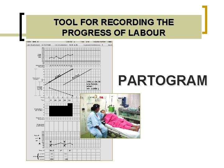 TOOL FOR RECORDING THE PROGRESS OF LABOUR PARTOGRAM 