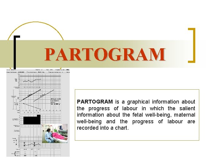 PARTOGRAM is a graphical information about the progress of labour in which the salient