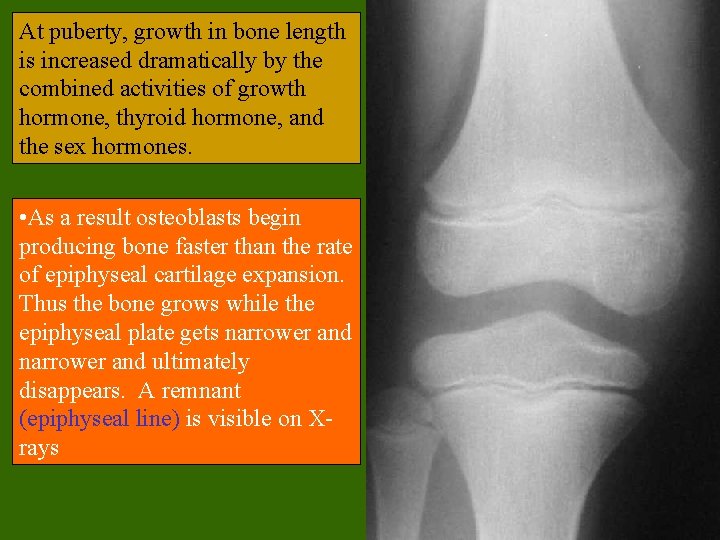 At puberty, growth in bone length is increased dramatically by the combined activities of At puberty, growth in bone length is increased dramatically by the combined activities of