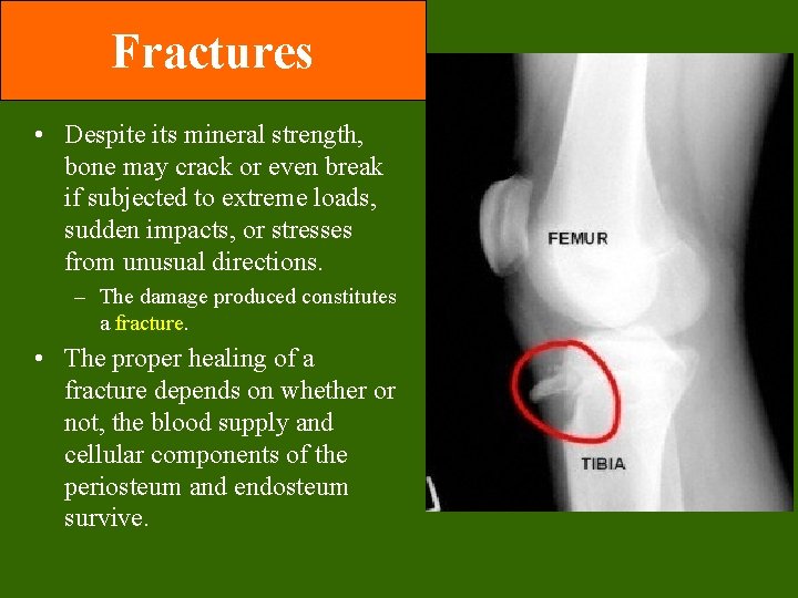 Fractures • Despite its mineral strength, bone may crack or even break if subjected Fractures • Despite its mineral strength, bone may crack or even break if subjected