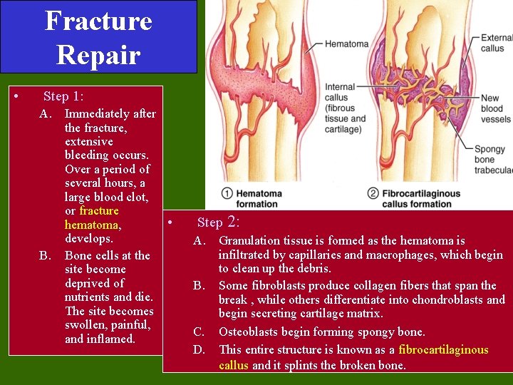 Fracture Repair • Step 1: A. Immediately after the fracture, extensive bleeding occurs. Over Fracture Repair • Step 1: A. Immediately after the fracture, extensive bleeding occurs. Over