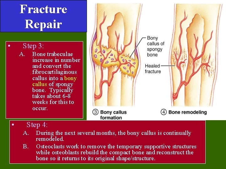 Fracture Repair • Step 3: A. • Bone trabeculae increase in number and convert Fracture Repair • Step 3: A. • Bone trabeculae increase in number and convert