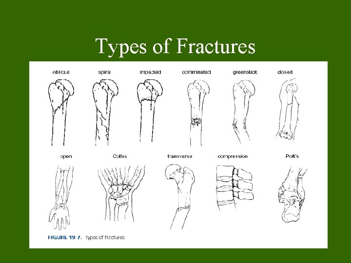 Types of Fractures Types of Fractures