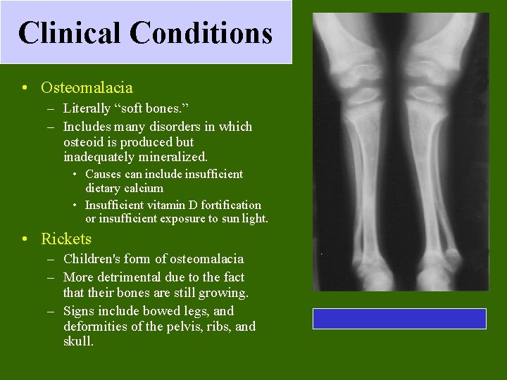 Clinical Conditions • Osteomalacia – Literally “soft bones. ” – Includes many disorders in Clinical Conditions • Osteomalacia – Literally “soft bones. ” – Includes many disorders in