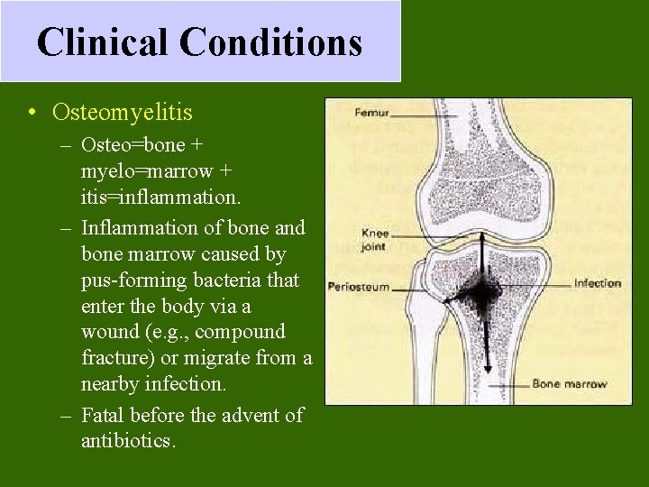 Clinical Conditions • Osteomyelitis – Osteo=bone + myelo=marrow + itis=inflammation. – Inflammation of bone Clinical Conditions • Osteomyelitis – Osteo=bone + myelo=marrow + itis=inflammation. – Inflammation of bone