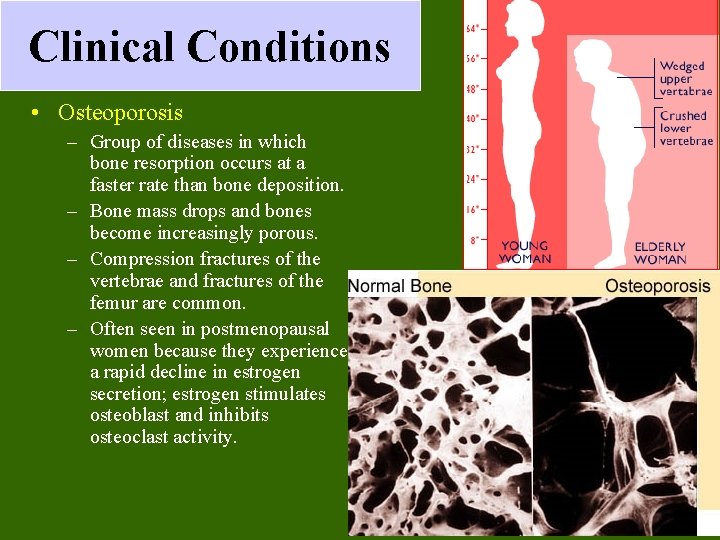 Clinical Conditions • Osteoporosis – Group of diseases in which bone resorption occurs at Clinical Conditions • Osteoporosis – Group of diseases in which bone resorption occurs at