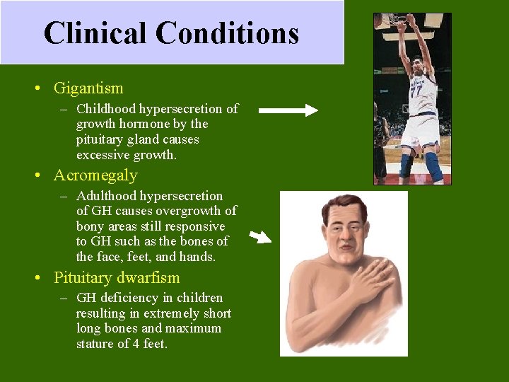 Clinical Conditions • Gigantism – Childhood hypersecretion of growth hormone by the pituitary gland Clinical Conditions • Gigantism – Childhood hypersecretion of growth hormone by the pituitary gland