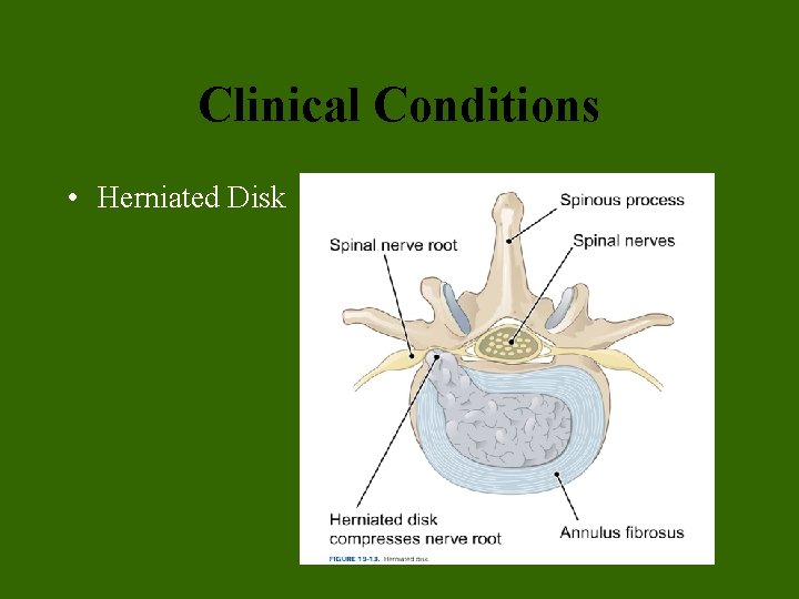 Clinical Conditions • Herniated Disk Clinical Conditions • Herniated Disk