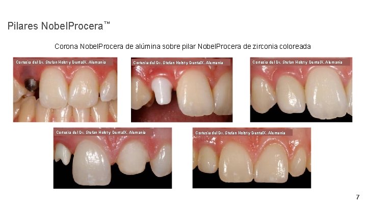 Pilares Nobel. Procera™ Corona Nobel. Procera de alúmina sobre pilar Nobel. Procera de zirconia