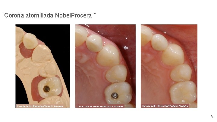 Corona atornillada Nobel. Procera™ Cortesía del Dr. Stefan Holst/Dental-X, Alemania 8 