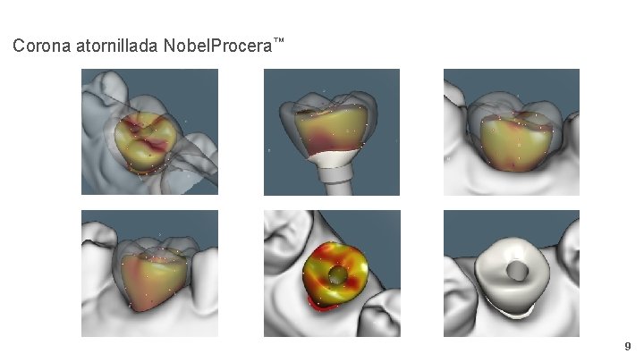 Corona atornillada Nobel. Procera™ 9 