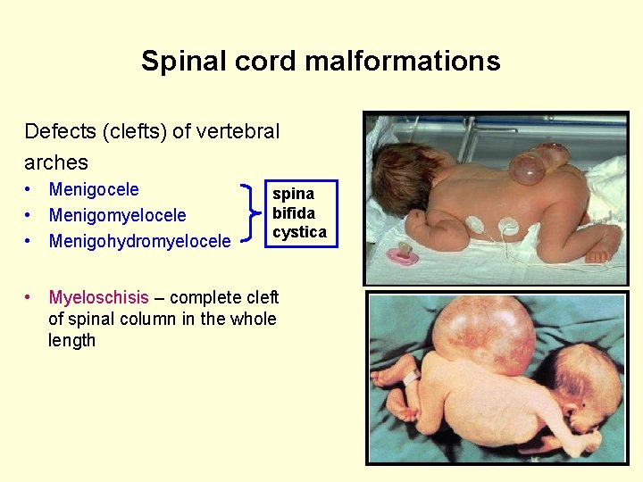 Spinal cord malformations Defects (clefts) of vertebral arches • Menigocele • Menigomyelocele • Menigohydromyelocele