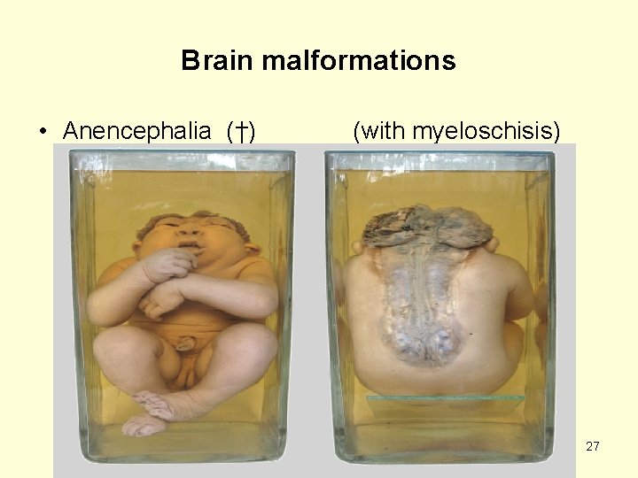 Brain malformations • Anencephalia (†) (with myeloschisis) 27 