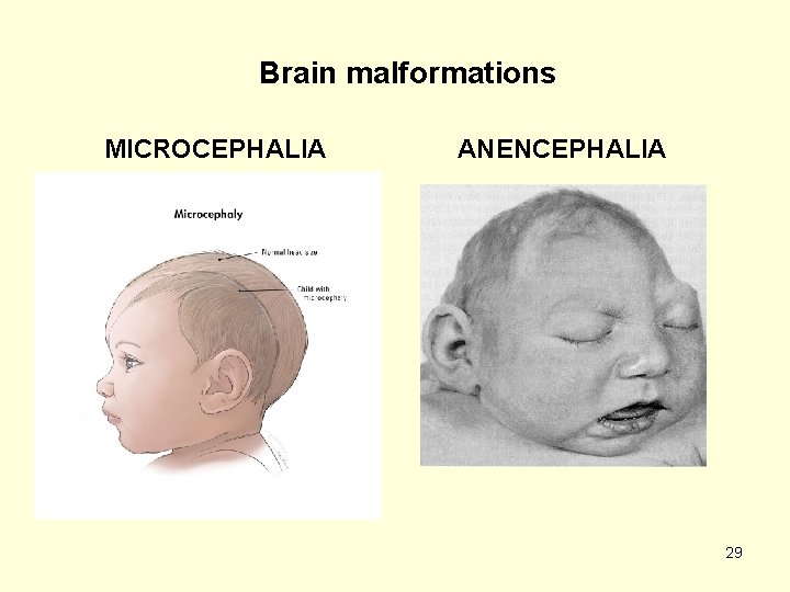 Brain malformations MICROCEPHALIA ANENCEPHALIA 29 