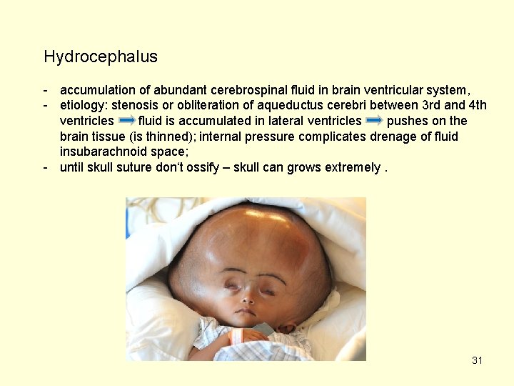 Hydrocephalus - accumulation of abundant cerebrospinal fluid in brain ventricular system, - etiology: stenosis