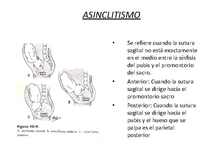 ASINCLITISMO • • • Se refiere cuando la sutura sagital no está exactamente en