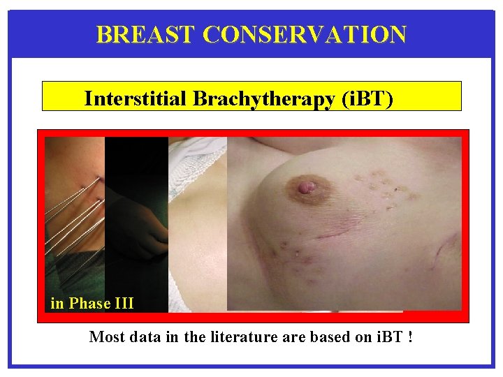 BREAST CONSERVATION Interstitial Brachytherapy (i. BT) in Phase III Most data in the literature