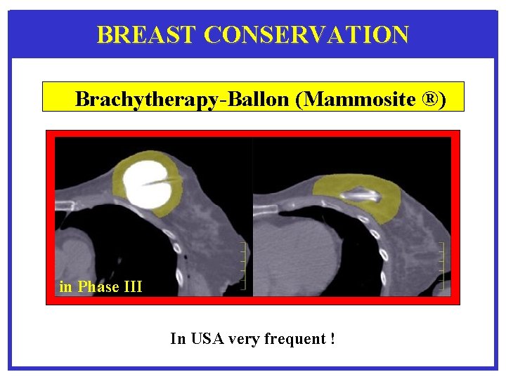 BREAST CONSERVATION Brachytherapy-Ballon (Mammosite ®) in Phase III In USA very frequent ! 