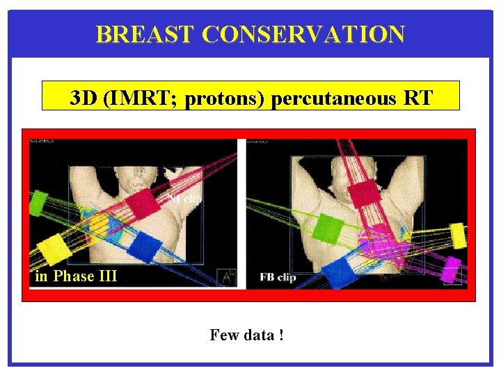 BREAST CONSERVATION 3 D (IMRT; protons) percutaneous RT in Phase III Few data !