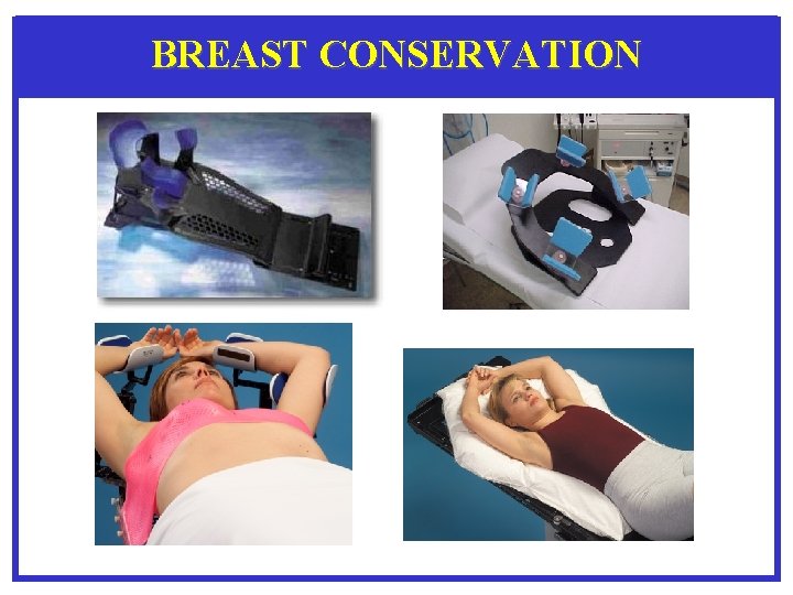 BREAST CONSERVATION 