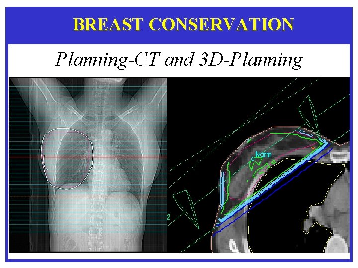 BREAST CONSERVATION Planning-CT and 3 D-Planning 
