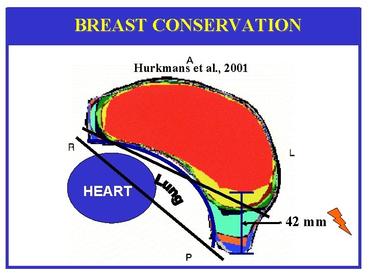 BREAST CONSERVATION Hurkmans et al. , 2001 HEART 42 mm 