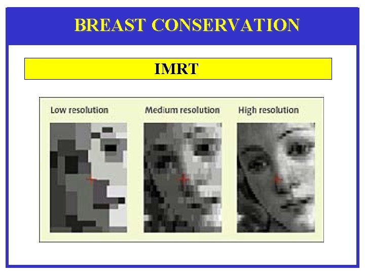 BREAST CONSERVATION IMRT 