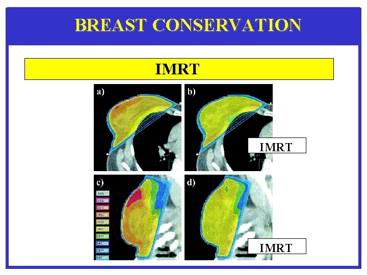 BREAST CONSERVATION IMRT 