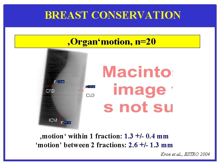 BREAST CONSERVATION ‚Organ‘motion, n=20 ‚motion‘ within 1 fraction: 1. 3 +/- 0. 4 mm