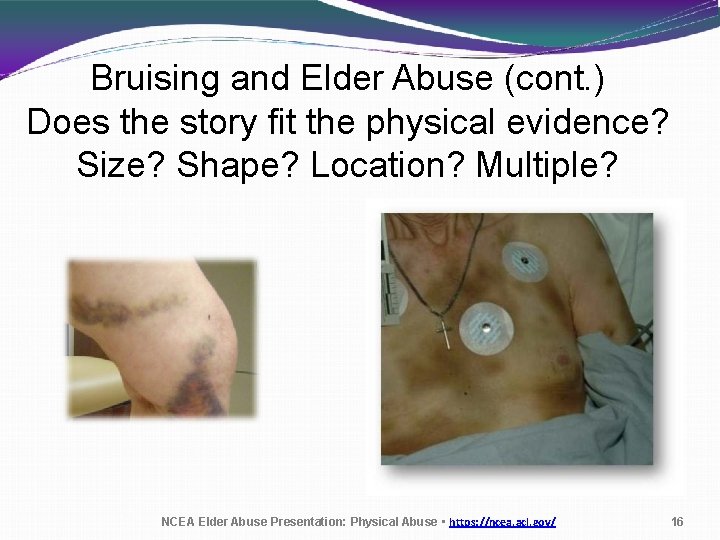 Bruising and Elder Abuse (cont. ) Does the story fit the physical evidence? Size?