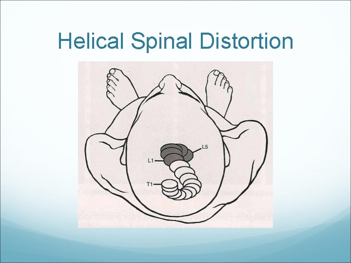 Helical Spinal Distortion 