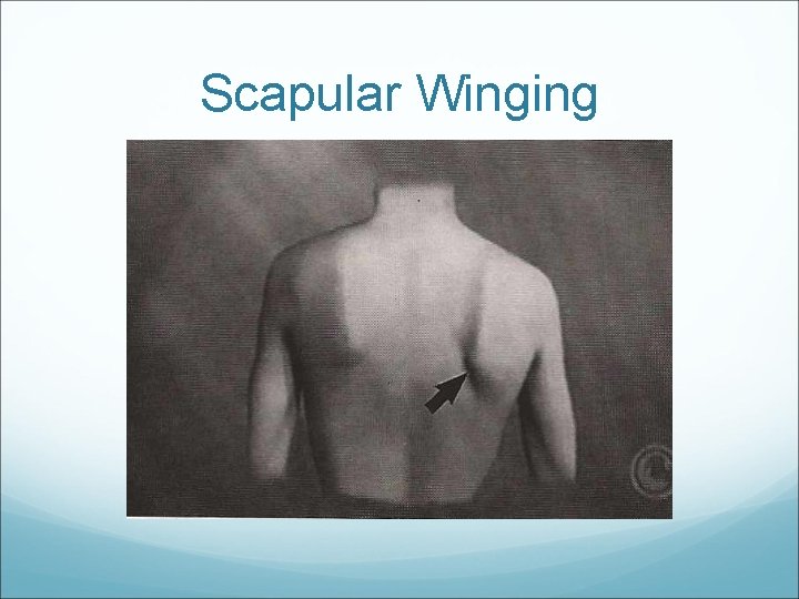 Scapular Winging 