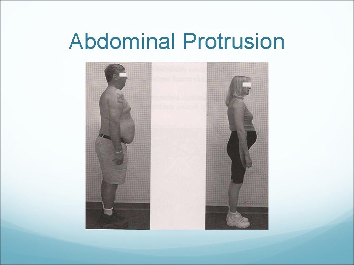 Abdominal Protrusion 