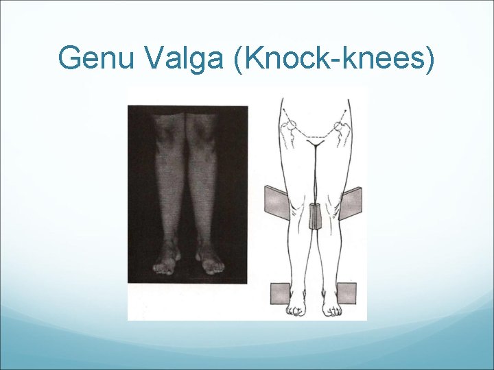 Genu Valga (Knock-knees) 