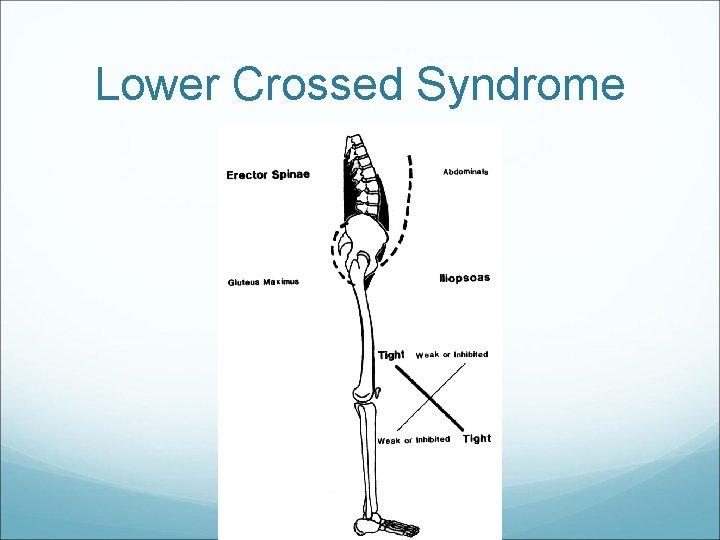 Lower Crossed Syndrome 