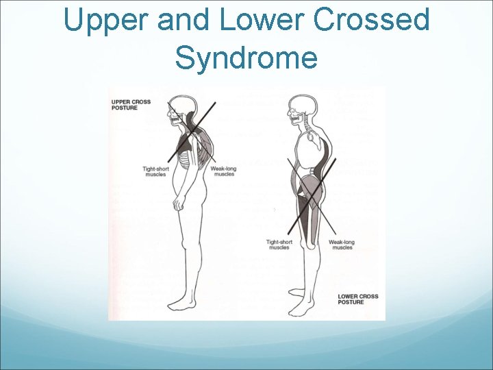 Upper and Lower Crossed Syndrome 