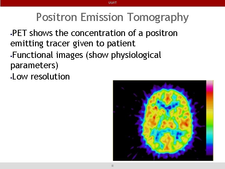 UU/IT Positron Emission Tomography PET shows the concentration of a positron emitting tracer given