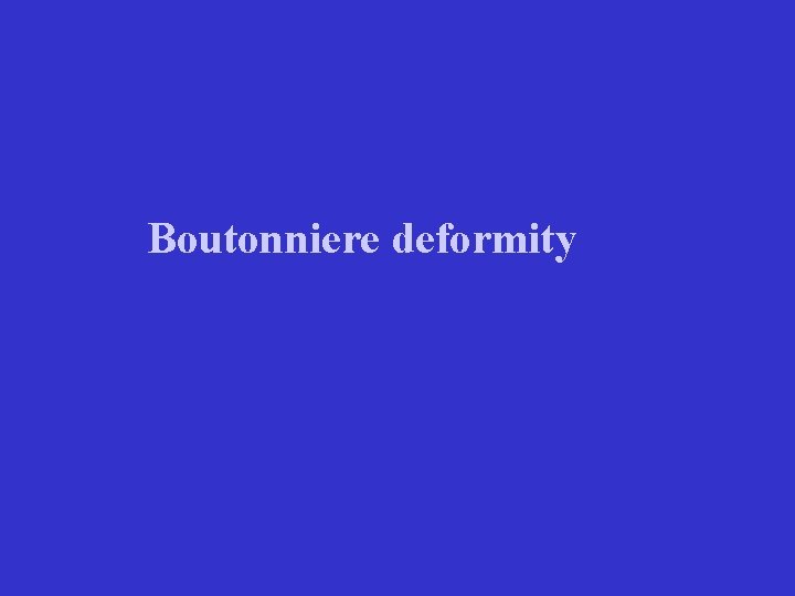 Boutonniere deformity 