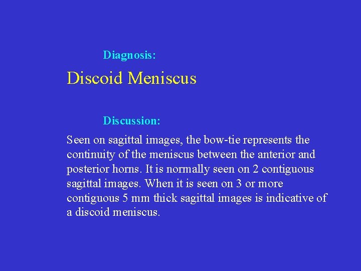Diagnosis: Discoid Meniscus Discussion: Seen on sagittal images, the bow-tie represents the continuity of