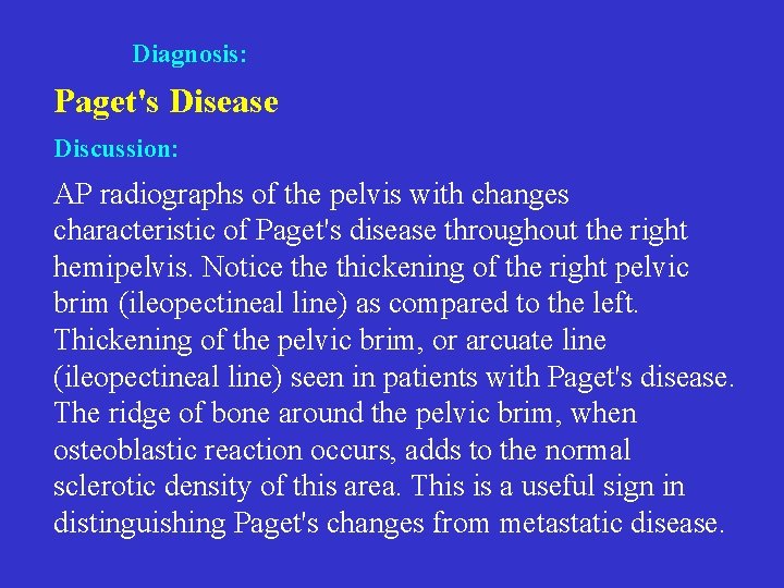 Diagnosis: Paget's Disease Discussion: AP radiographs of the pelvis with changes characteristic of Paget's