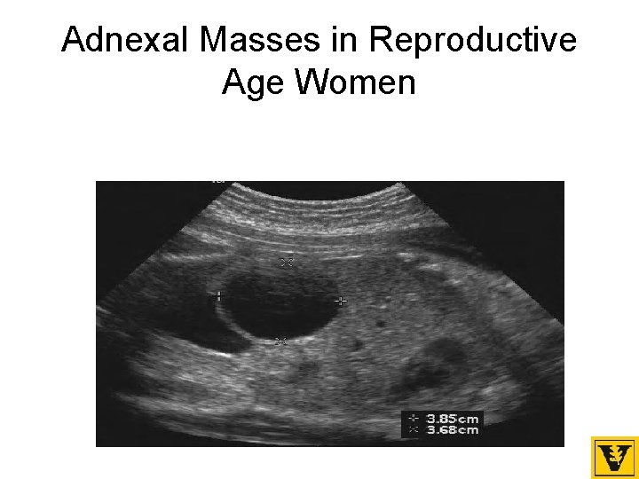 Adnexal Masses in Reproductive Age Women 