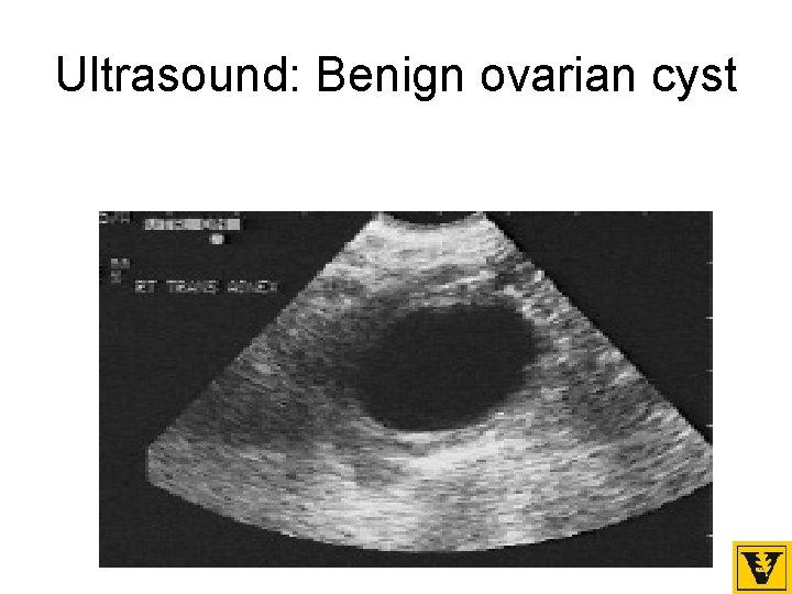 Ultrasound: Benign ovarian cyst 