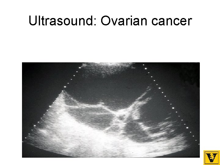 Ultrasound: Ovarian cancer 