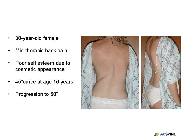  • 38 -year-old female • Mid-thoracic back pain • Poor self esteem due