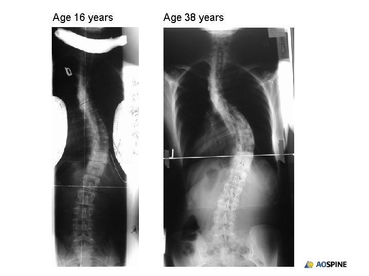 Age 16 years Age 38 years 